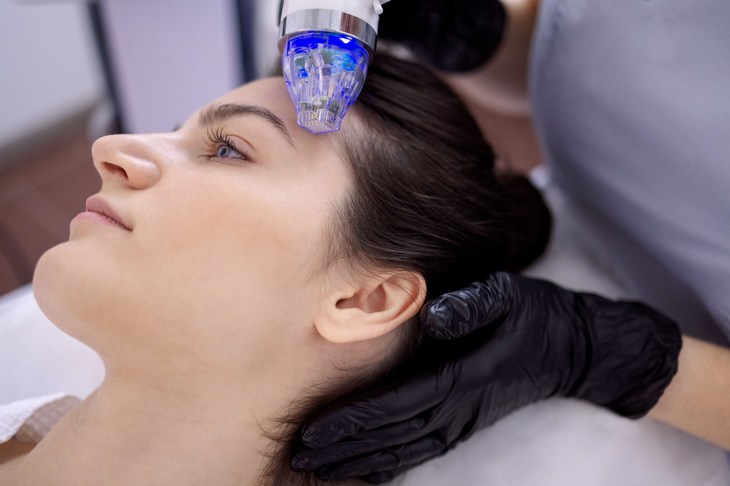 Fractional Rf Microneedling In Singapore - IDS Clinic